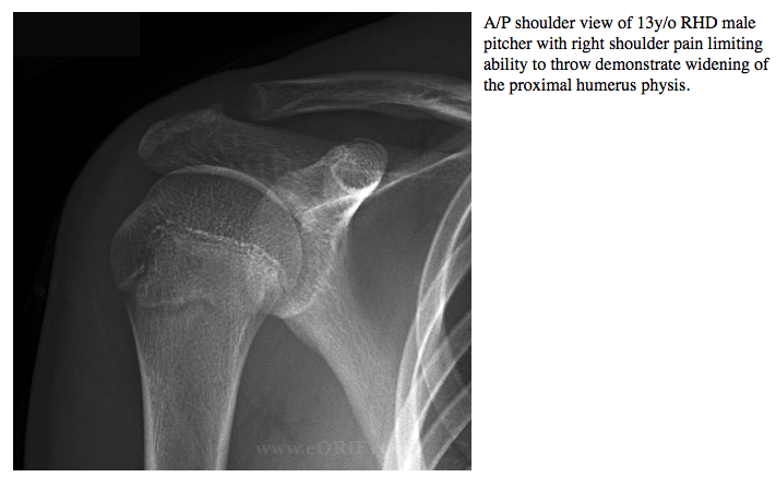 Little League Shoulder M89.9 733.9 eORIF
